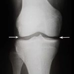 Nakon 1–2 mjeseca uzimanja